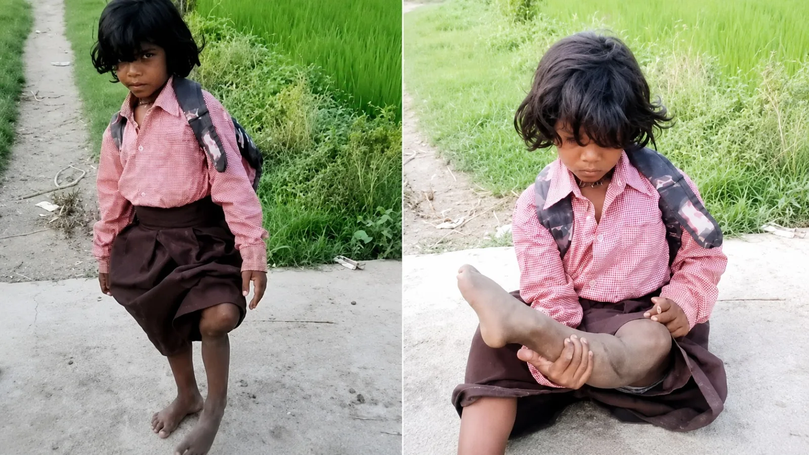 ఏడేళ్ల పాప.. ఒంటికాలితో గెంతుతూ బడికి!